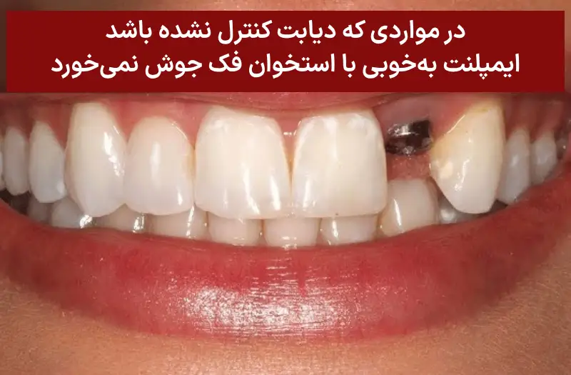 ایمپلنت در افراد دیابتی