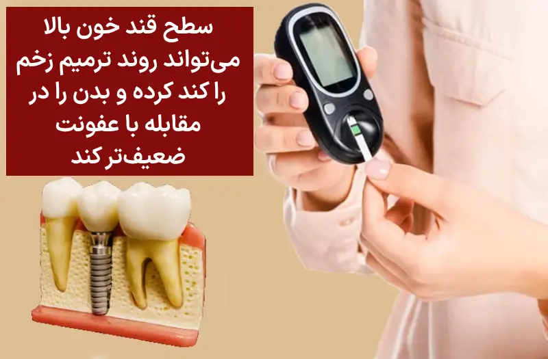 ایمپلنت و قند خون