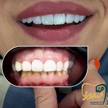 عکس-لمینت-سرامیکی-دندان