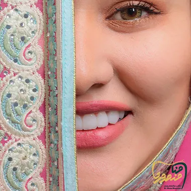 عکس لمینت سرامیکی دندان