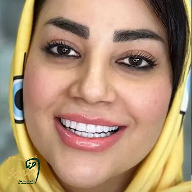 عکس-کامپوزیت-ونیر
