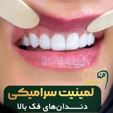 لمینت-سرامیکی-دندان-فک-بالا