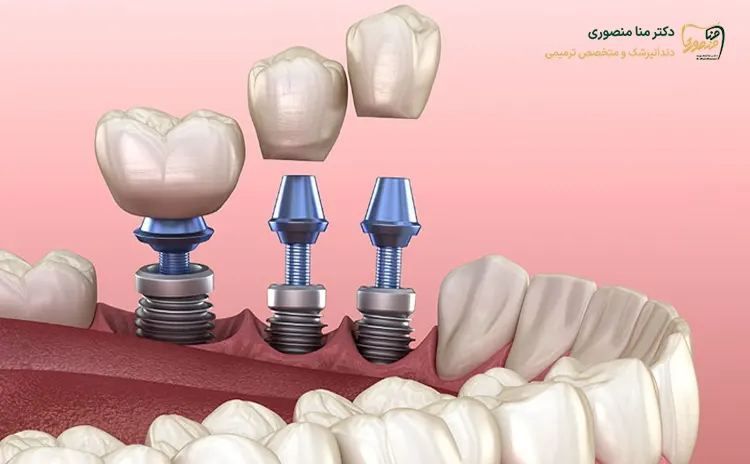 مزایای ایمپلنت دندان