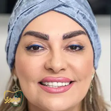 کامپوزیت-ونیر-دندان