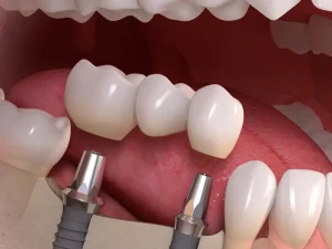 روش های مختلف کاشت ایمپلنت برای بیماران دیابتی