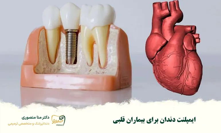 ایمپلنت دندان برای بیماران قلبی