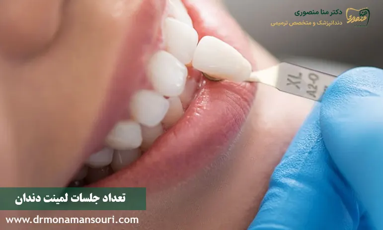 تعداد جلسات لمینت دندان