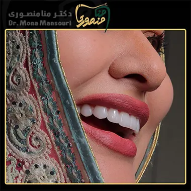 لمینت دندان