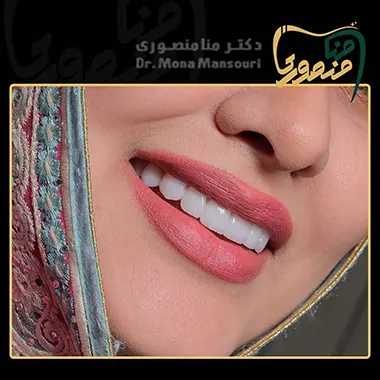نمونه کار لمینت دندان