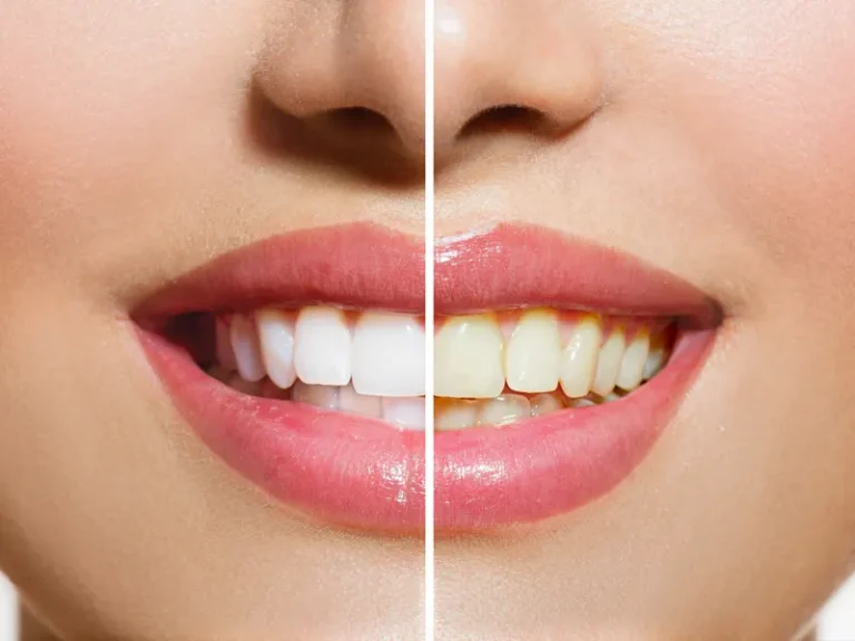 تفاوت بلیچینگ دندان در مطب و خانه در معایب