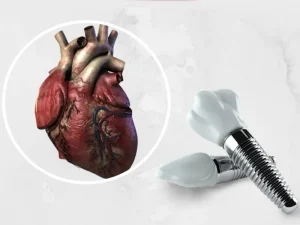 شرایط لازم کاشت ایمپلنت برای بیماران قلبی