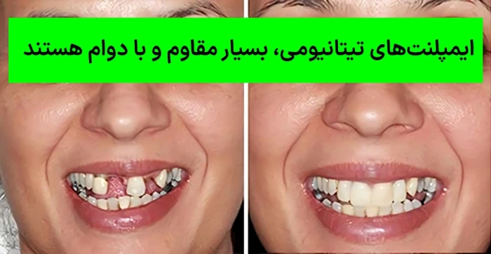 ایمپلنت دندان قدامی