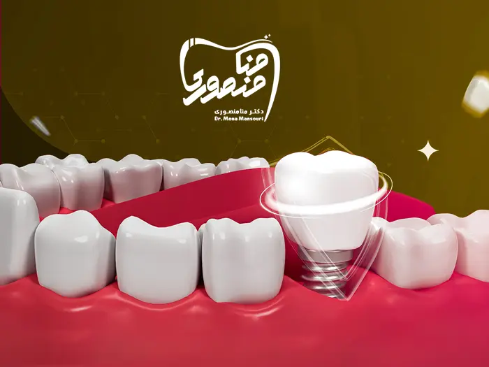 ایمپلنت دندان