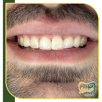 بعد کامپوزیت ونیر
