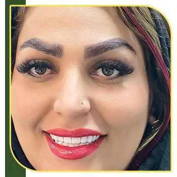 عکس لمینت دندان بانوان