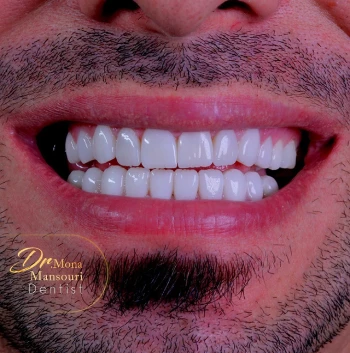عکس لمینت دندان