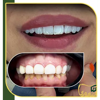 عکس لمینت دندان