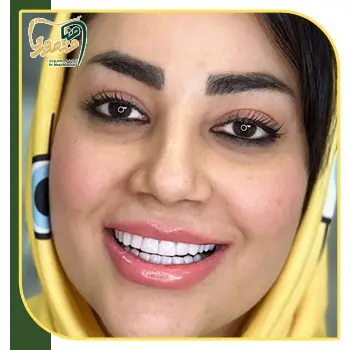 عکس کامپوزیت دندان دکتر منصوری
