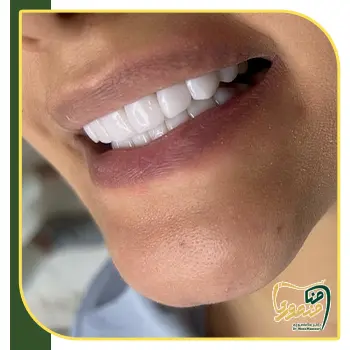 عکس کامپوزیت دندان