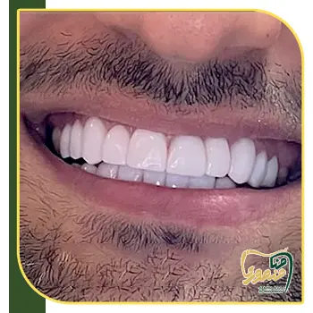 عکس کامپوزیت دندان