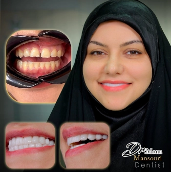 عکس لمینت دندان
