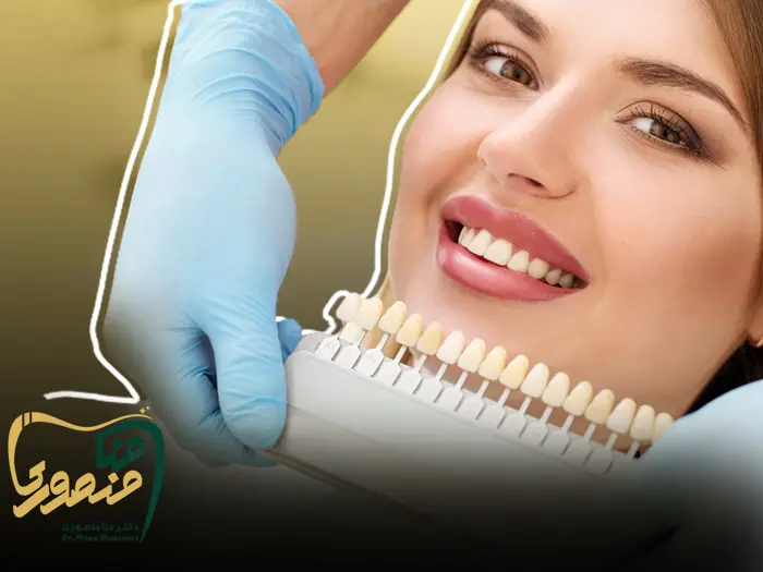 لمینت سرامیکی