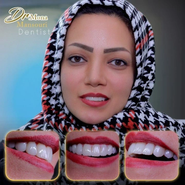 نمونه لمینت دندان