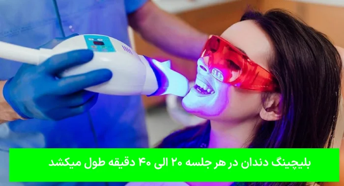 مدت زمان بلیچینگ دندان