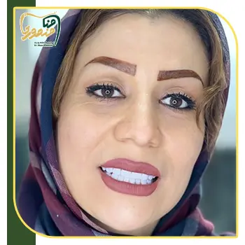 نتیجه کامپوزیت دندان