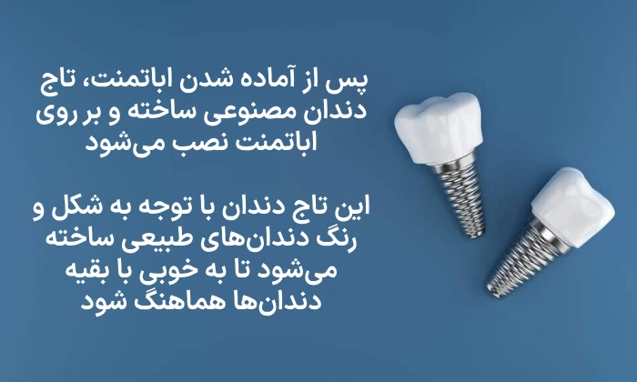 نصب ایمپلنت دندان جلو