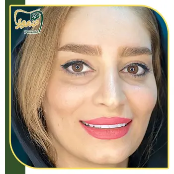 نمونه کار کامپوزیت دندان
