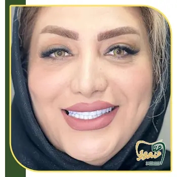 نمونه کامپوزیت دندان خانم ها