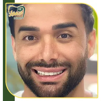 نمونه کامپوزیت فک بالا