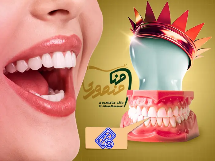 هزینه لمینت دندان