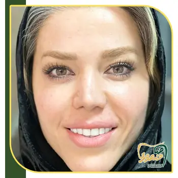 کامپوزیت دندان نمونه کار