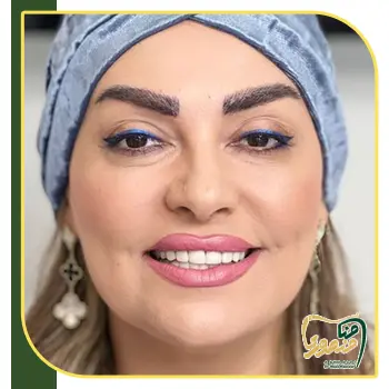 کامپوزیت ونیر قبل و بعد