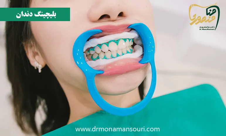 بلیچینگ کردن دندان