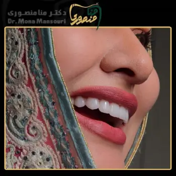 نمونه کار بعد از لمینت دندان