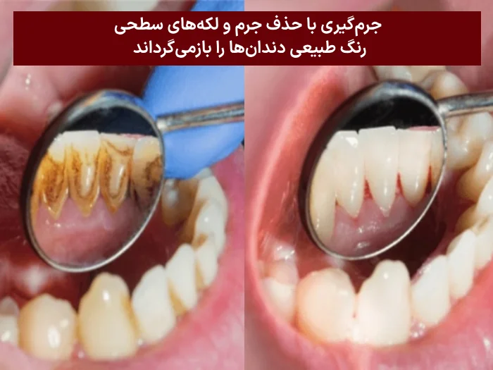 سفید کردن دندان با جرم گیری