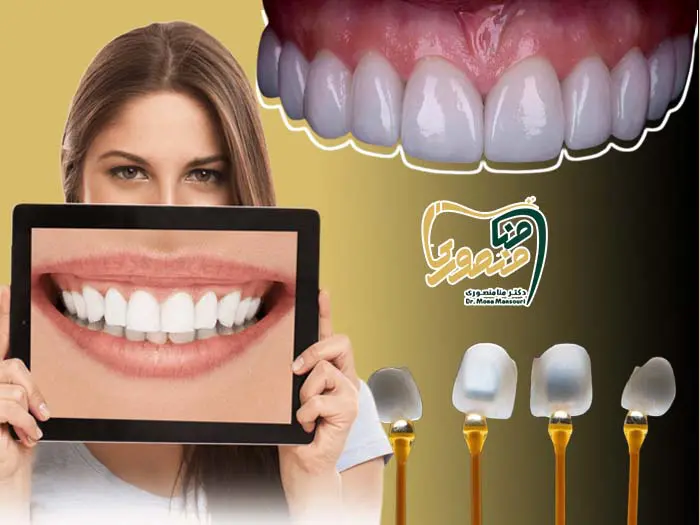 فرق لمینت و کامپوزیت
