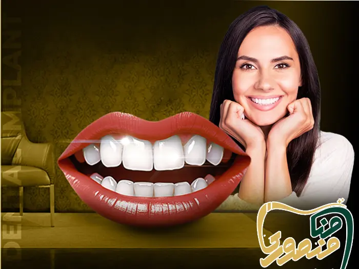 لمینت برای دندان خرگوشی