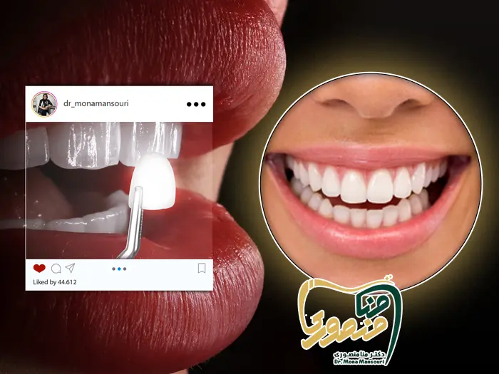 لمینت دندان خرگوشی
