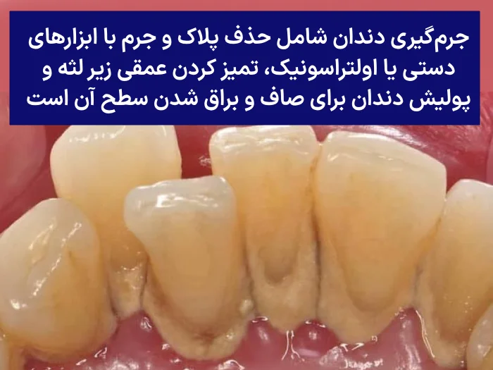 مراحل جرم گیری دندان