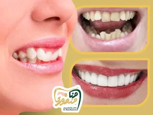 لمینت دندان کج