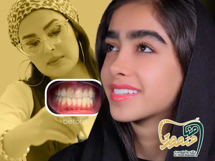 اصلاح طرح لبخند