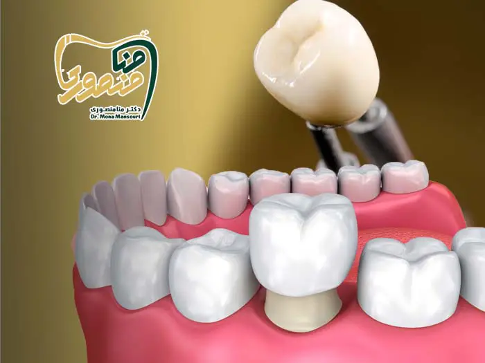مراحل روکش دندان