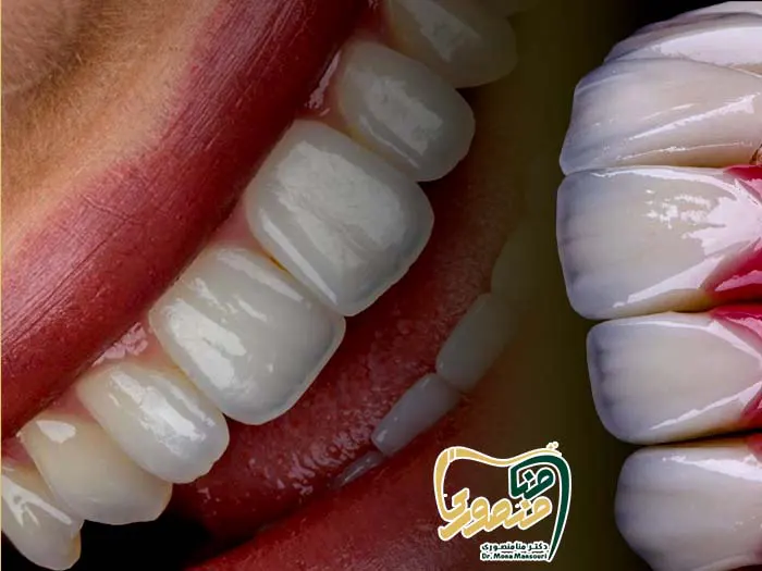 لمینت شیشه ای دندان