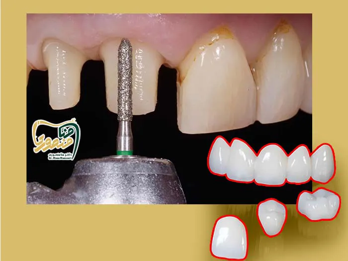 میزان تراشیدن دندان برای لمینت