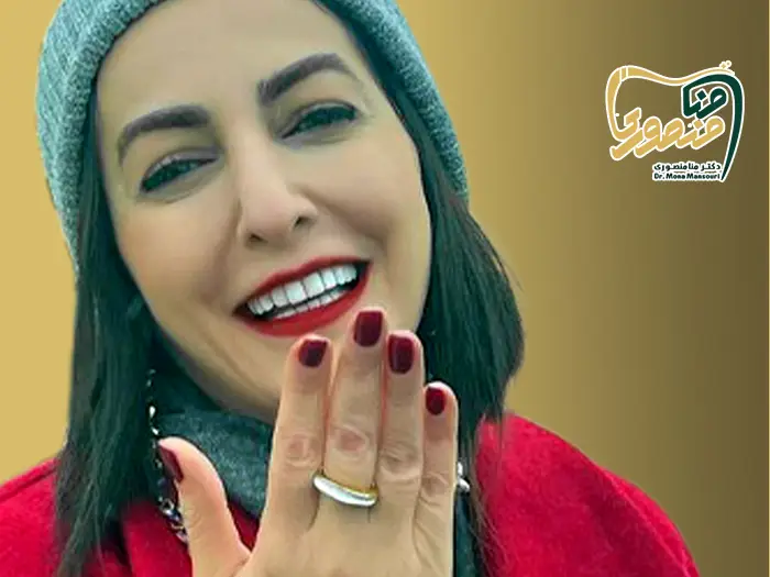 لمینت دندان بازیگران