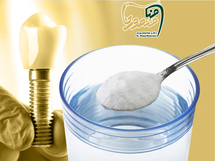 نمک بعد ایمپلنت دندان